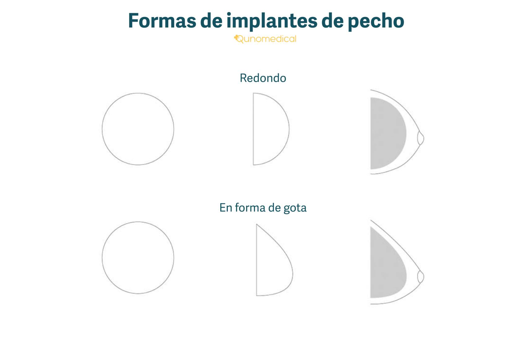 Las diferentes formas de los implantes mamarios.